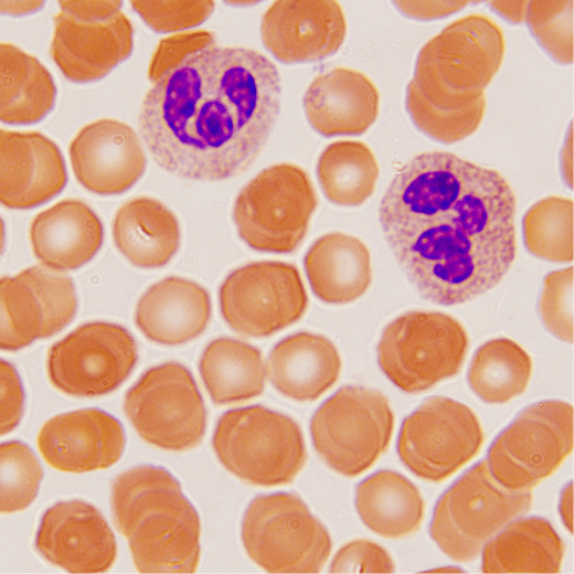 Quick III stain of a blood sample with white blood cells and RBCs